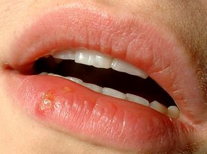 Illustration for article titled Medications and Dietary Supplements to
Incorporate For Managing Herpes